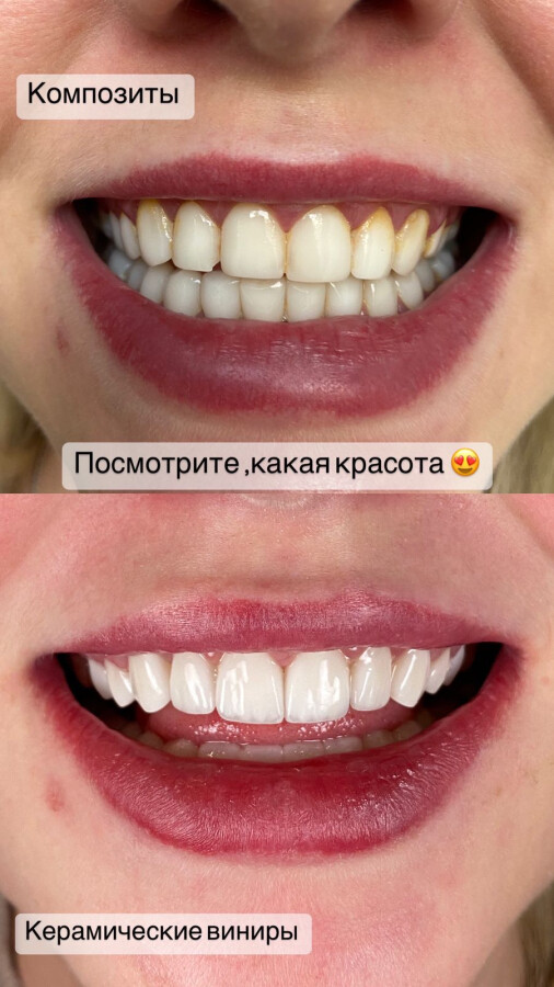 16 важных вопросов и ответов про виниры фото 11